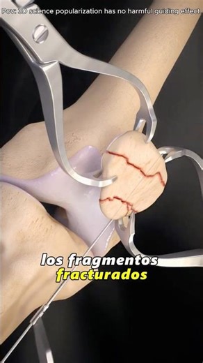 Patellar fracture surgery (3D animation)#3dmedicalanimation #medical3danimation #knee-surgery