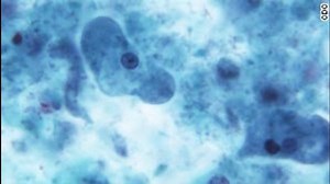 E. coli mystery solved: Ground beef is source of outbreak, CDC says