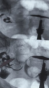 X-ray image of Hysterosalpingography (HSG). MRI with contrast agent. Patency of the uterus, ovaries and fallopian tubes. Uterine tubes, analysing female reproductive system. Infertility treatment.
