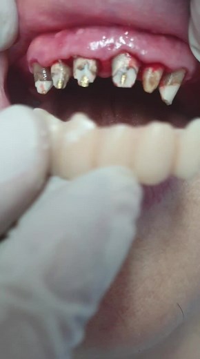 Dental Procedure: Extraction of Damaged Teeth Explained