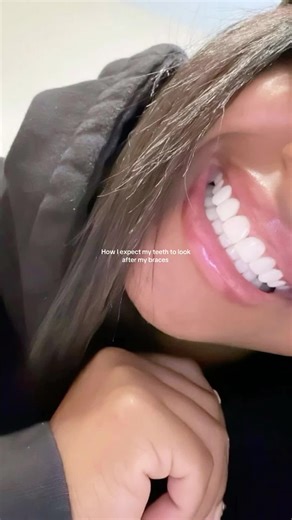 Perfect #teeth #dreaming #dreamsmile #letmebefamous #letthisblowup