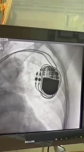 Dual Chamber Pacemaker - Dr Md Faizuddin