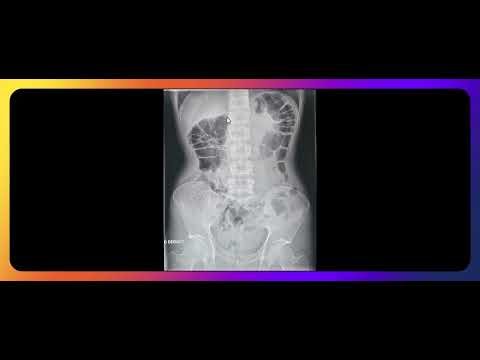 Comment interpréter une radiographie d'abdomen sans préparation (ASP) de face ?