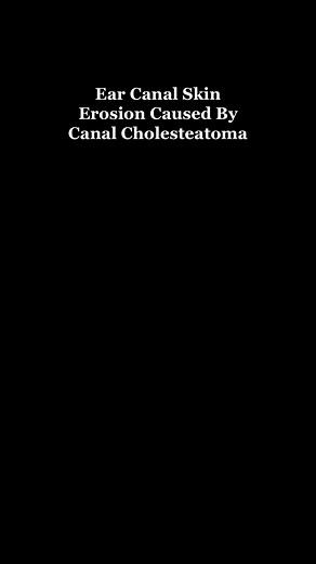 Understanding Ear Canal Skin Erosion and Canal Cholesteatoma