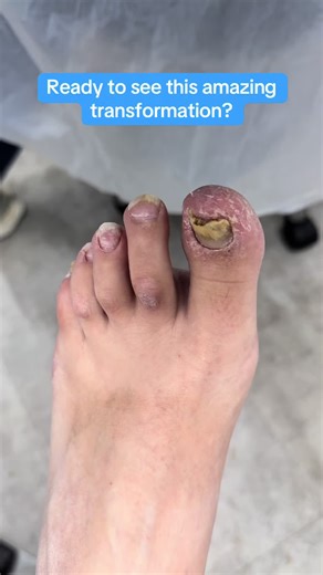 Fungal Nail Transformation with Laser Treatment
