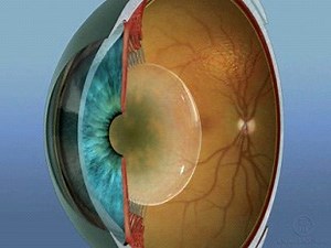 Cataratta: Sintomi, Cause, Intervento, Convalescenza e Costo