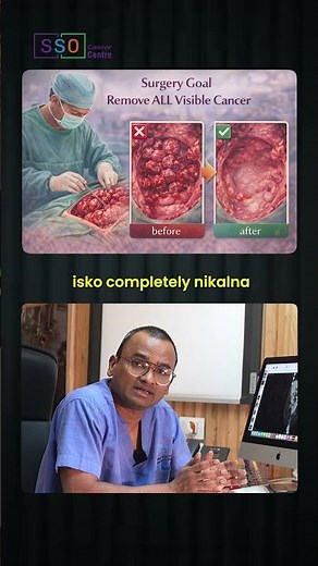 HIPEC With Cytoreductive Surgery Explained In 30 Seconds! | Dr Praveen Kammar, Mumbai