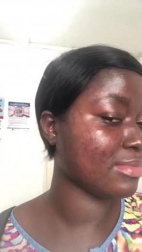 You Won’t Believe This Transformation 😱 | Black Skin Acne Cleared by Dermatologist