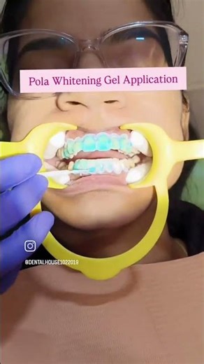 Teeth whitening// smile makeover #jaipurdentist #smiledesigndental #dentist