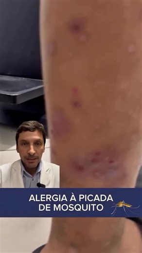 Andre Aguiar Gauderer on Instagram: "Alergia a picada de mosquito. 🦟 Nesse video explico o que é alergia a pocada de mosquito e como tratar. Se você ou seu filho sofrem com as picadas de mosquito descubra o que pode ser feito. #alergia #mosquito #prurigoestrófulo #mordidademosquito"