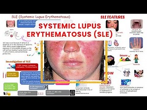 Lupus Signs & Symptoms (& Why They Occur) | Skin, Joints, Organ Systems