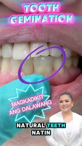 35 reactions · 7 comments | INTERESTING FACTS FROM DRA. ROCHELLE RUIZ Dagdag kaalaman about TOOTH GEMINATION  VISIT US FOR YOUR DENTAL NEEDS!!! Call/Text us at : +639063692166 ☎️(02) 8401 2634 Have a great teeth day! ⭐✨ #thedentalcentermanila #knowledge #knowledgeispower #toothgemination #tooth | The Dental Center Manila | Facebook