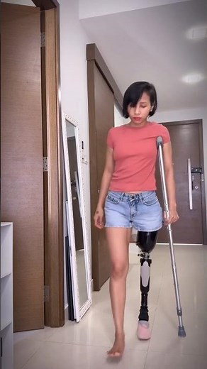 Above-Knee Amputee Girl Walks Again — From Crutches to Confidence | Inspiring Prosthetic Leg Journey