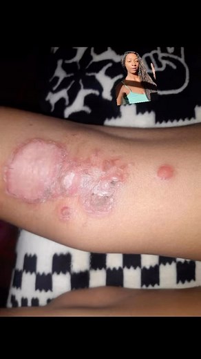 Natalya King 🦋 BodyLove by Tal Apothecary & Makery on Instagram: "Impetigo is a highly contagious skin infection that primarily affects infants and children, though it can occur in people of all ages. Impetigo is caused by bacteria, primarily either Staphylococcus aureus or Streptococcus pyogenes. Most times antibiotics are prescribed which destroys the microbiome in your gut! Antibiotics should not be the only option. My goal is to enlightening and empower you all to recognize and be receptive