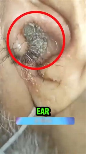 Worms in Your Ear NEVER Do This First Most People