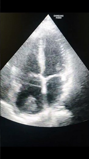 Right Atrial Myxoma on Echocardiography