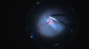 Subretinal Implantation of RPE on a Carrier in Minipigs: Guidelines for Preoperative Preparations, Surgical Techniques, and Postoperative Care
