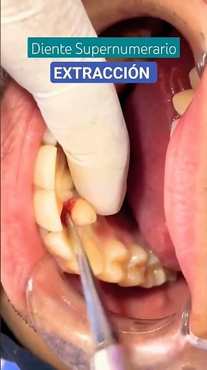 EXTRACCIÓN DENTAL de Diente Supernumerario #doctor #dentist #urgencias #enfermeria #odontologia