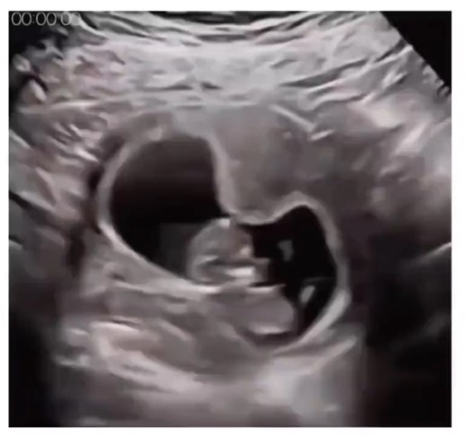 Baby hiccuping in the womb! 😇 | LifeNews.com