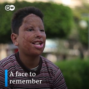 411K views · 6.6K reactions | “My dream is to become a doctor or an engineer, when I grow up.” Despite his scarred face and bullying by his classmates, 12-year-old Youssef won‘t give up his dreams. (via DW جعفر توك) | DW Stories | Facebook