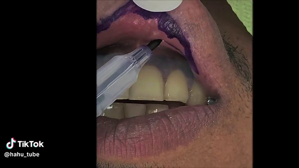 #dentalimplant #የከንፈር ማስተካከል