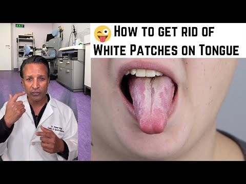 WHITE PATCHES on TONGUE: What do they mean and how to get rid of them 😜