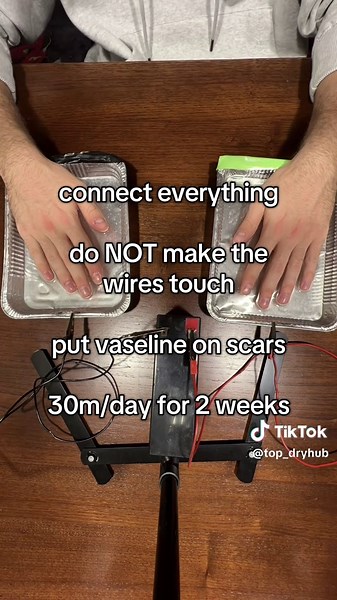 #hyperhidrosis #sweatyhands #sweat | Hyperhidrosis