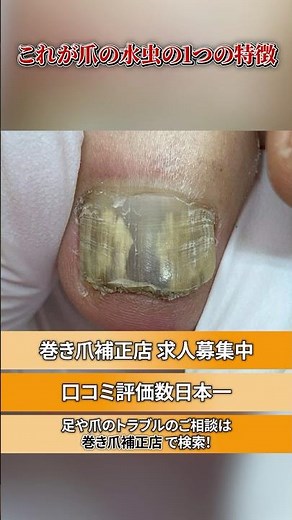 【注意】爪の水虫はカビです！！放置しても治らない爪の水虫について解説します