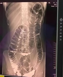 156K views · 122 reactions | This is an X-ray image of a young woman who suffered from chronic constipation. One day, after experiencing continuous symptoms for over two weeks, she went for a medical check-up and received the X-ray results shown below... | Gladwire | Facebook