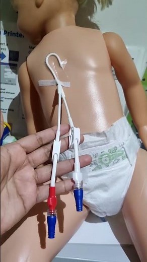 Broviac Catheter|Hickman line