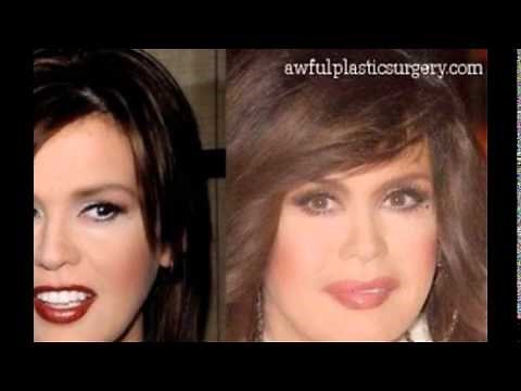 Marie Osmond plastic surgery before and after photos