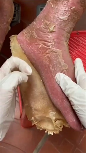 STOP Hiding Your Feet 😳 Fix Cracked Heels FAST at Home! #shorts