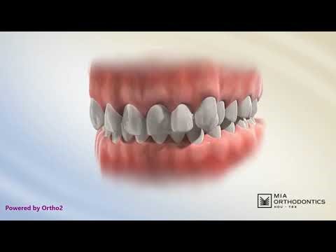 What Is a Class II Division 2 Bite? | Quick Explanation