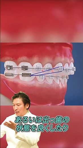 顎間ゴムの役割！#ワイヤー矯正 #矯正治療 #顎間ゴム