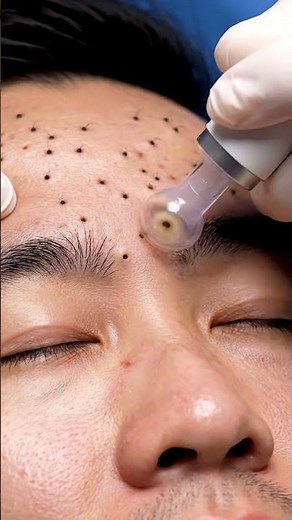 Professional Blackhead Removal with Pump Suction Machine | Relaxing ASMR 4K#022