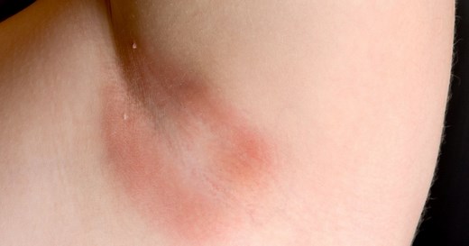 Yes, You Can Get A Yeast Infection In Your Armpit