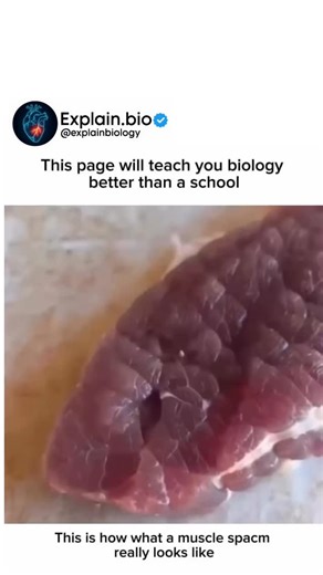 BIOLOGY | MEDICAL | HEALTH on Instagram: "“A muscle spasm can appear as a sudden, involuntary contraction or twitching of the muscle, often visible under the skin as a rapid, jerky movement, and may be accompanied by pain, stiffness, or a feeling of tightness in the affected area.” Follow for more @explain.bio #biology #medical #health #viral"