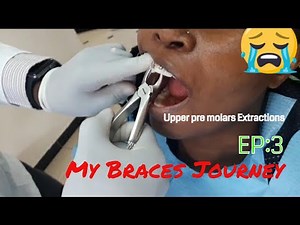 One Month Braces Update + Upper Pre Molars Extractions //vlog *Lots of needles *