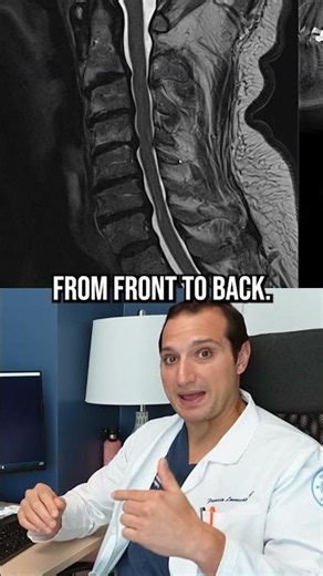 How a Standalone ACDF Treats a Pinched Spinal Cord