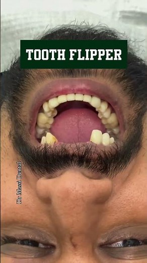 PARTIAL DENTURE