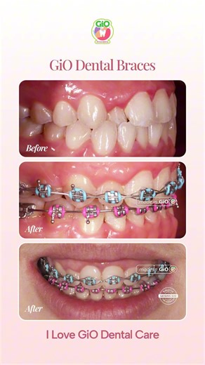 GiO Dental Braces | Trapped Incisor