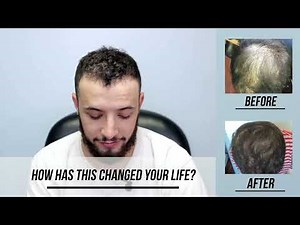 STEM CELL Hair Restoration for Hair Loss with before and after photos