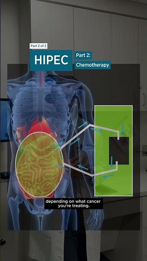 Fighting Cancer with HIPEC: Doctor Explains the Procedure