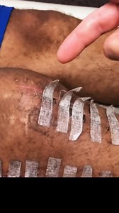 43K views · 224 reactions | Sometimes steri strips don't completely come off on their own. Your physical therapist can tell you when it is safe to take them off. #kneesurgery | Total Therapy Solutions: Physical Therapy | Facebook