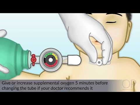 Changing a Tracheostomy Tube by J. Nobrega, M. DeGrazia | OPENPediatrics