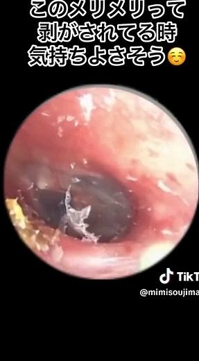 耳掃除動画で耳垢をスッキリ除去する方法