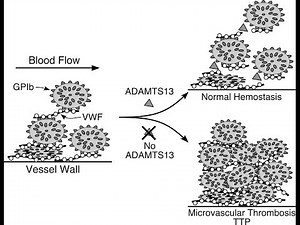 Thrombotic Thrombocytopenic Purpura (TTP)