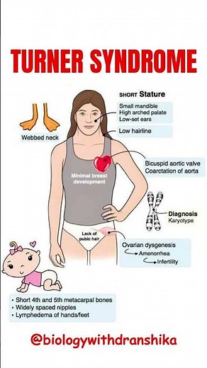 Turner Syndrome: One X chromosome, a thousand challenges – but infinite strength! #turnersyndrome