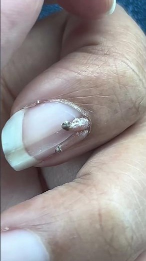 Close-Up of Damaged Fingernail with Skin Deterioration: Nail Health Concerns#NailDamage