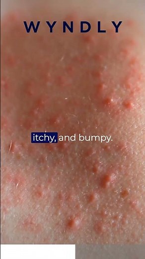 Can strawberries cause a rash?